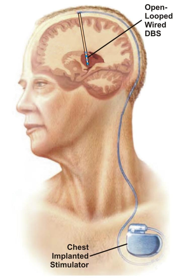 Deep Brain Stimulation Constant high-frequency (130 Hz) stimulation to the internal segment of the globus pallidum (GPi)