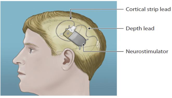 Open-loop: Vagus Nerve Stimulator