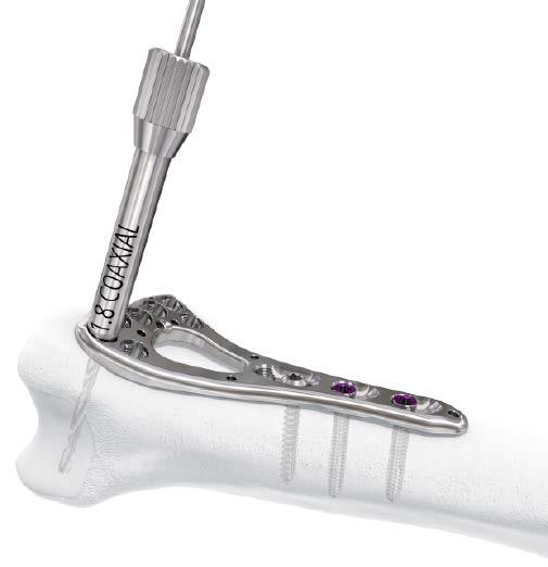 Implantation Steps 4. Insertion of distal screws For used instruments, please refer to page 13. 4a.