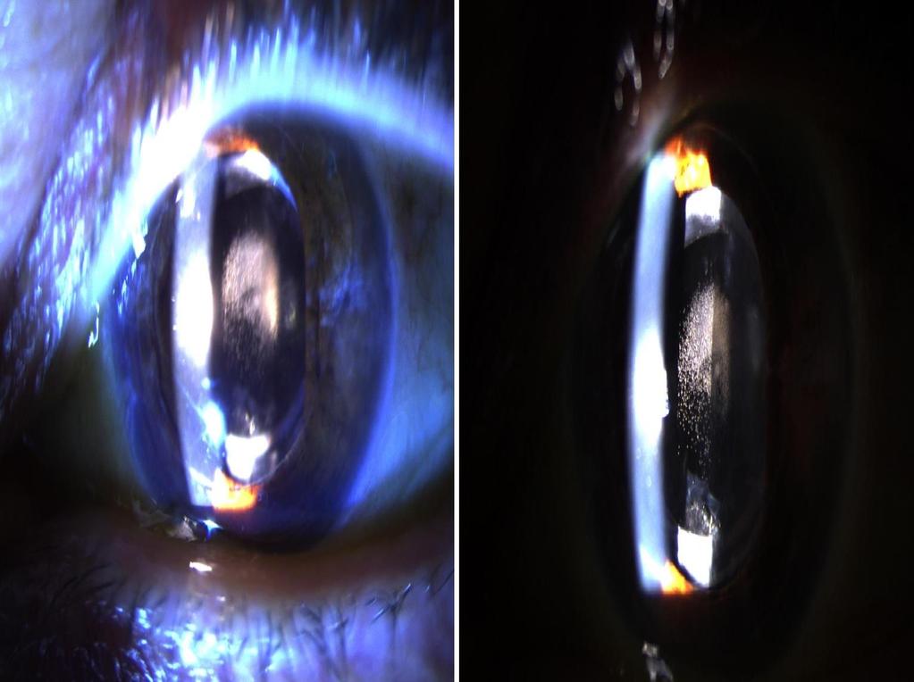 Tips & Pearls If a patient has Fuch s dystrophy and cataract, you should proceed in cataract surgery using hydrophobic
