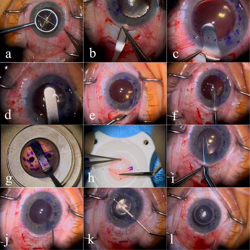 Terry allows it to be completely removed from the anterior segment with simple irrigation and aspiration and does not allow Healon to coat the cut recipient stromal surface (unpublished data).