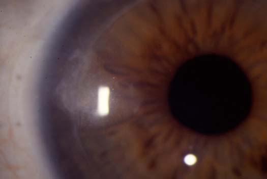 Terry in Figure 3. There were no cases of interface inflammation, such as the deep lamellar keratitis seen as a complication with LASIK surgery.