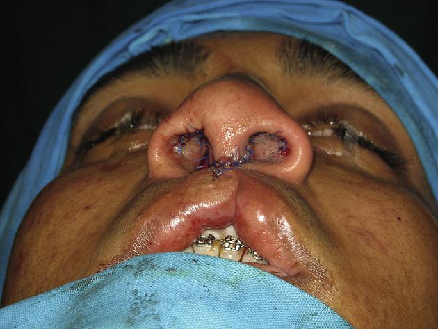 Evaluation of the outcome of secondary rhinoplasty in cleft lip and palate patients 31 Figure 11 Shield and Strut graft. breathing.
