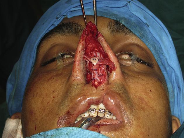 nostril. All patients were satisfied with the outcome of the surgery and even expressed they would undergo such a procedure a second time if necessary.