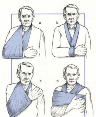 Types of slings: a- Broad arm sling b- Collar and
