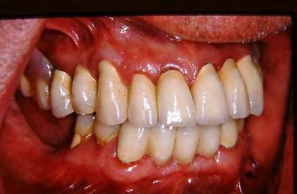 Adjacent teeth can be preserved.