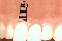 3. How can dental implants support a