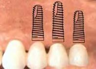 Dental implants act as anchors for a