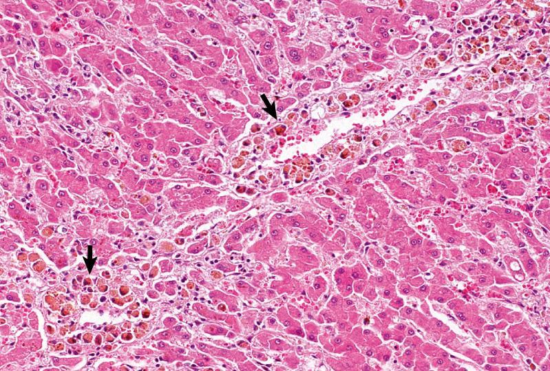 ALTERATIONS IN BLOOD FLOW & PERFUSION - CONGESTION Histopathology: Chronic hepatic congestion Hepatic Congestion In zone 3 Hemosiderin