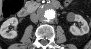 Calcifications Type II endoleak Use radiologist as a consultant rather than lab service. Radiologists can add value to patient care. Incidental adrenal nodules under 1 cm can be ignored.
