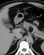6% of CTs (10% in > 70- years age) 1 show adrenal incidentaloma (AI) 3-5% of AI are