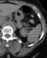 2%) had isolated adrenal met (all > 6 cm size) Retrospective review of 973 patients (not