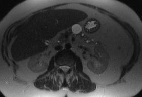 risk Pancreatic head cyst with CBD obstruction Main PD 10 mm Enhancing