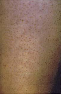 Keratosis follicularis spinulosa decalvans (KFSD) is also a genetically heterogeneous syndrome characterized also with KPA, but contrary to UO, which particularly and initially, to a greater or