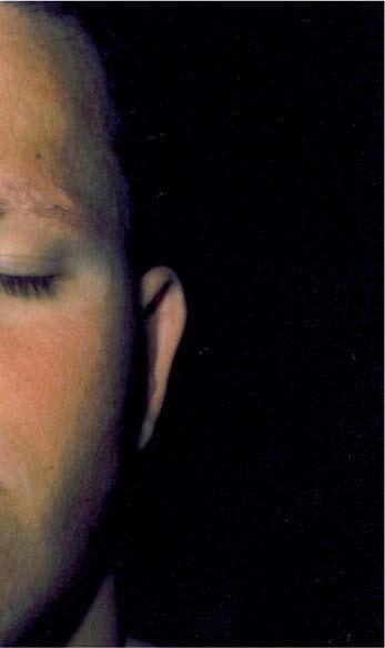 CASE REPORT Serbian Journal of Dermatology and Venereology 2015; 7 (3): 129-138 Figure 3. Erythema of the face Dermatoglyphic findings: normal, unremarkable.