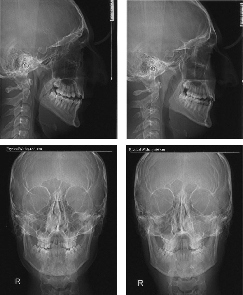 Figure 3. Panoramic View of the Patients Right side patient M.H s and left side A.
