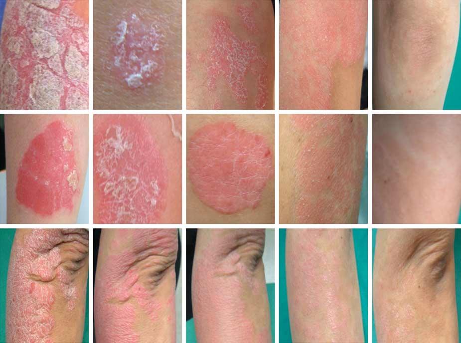 Very severe Severe Moderate Mild None A B C D E F G H I J K L M N O Induration Erythema Scaling Figure 4. Clinical examples. A-E, Rating scaling; F-J, erythema; and K-O, induration.