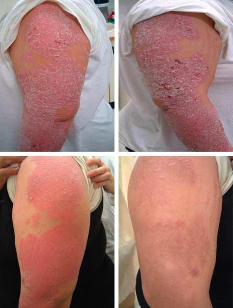 induration scores by treating with indigo naturalis ointment or vehicle only; however, the erythema and area scores revealed obvious changes only by indigo naturalis ointment.