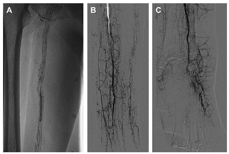 Renal insufficiency is independently associated with a distal distribution pattern Diffuse severe calcification: (A) along the SFA; (B) occlusion of the distal ATA and proximal