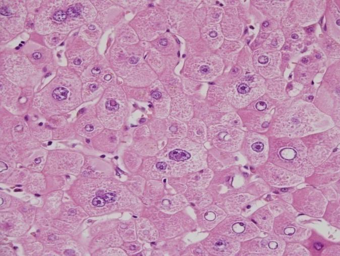Morphological features Large liver cell change (LLCC) Foci of cellular