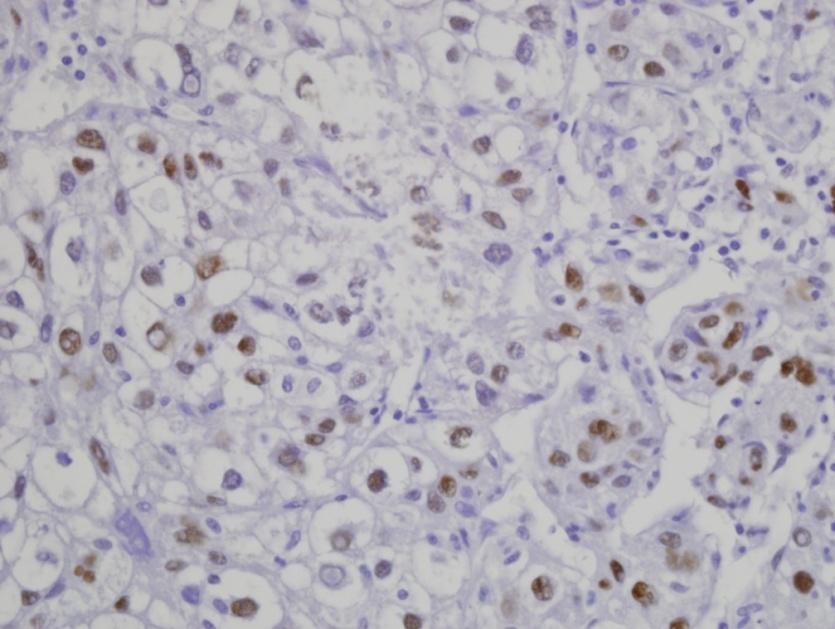 Tumor suppressor gene, p53 p53 mutation/tp53 overexpression Poor differentiation High proliferative activity High recurrence rate 5 small HCC with