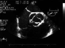 Figure 13: Short-axis view of the aortic valve and coronary arteries LA RA NC RCA LCA PA RA: right atrium; LA: