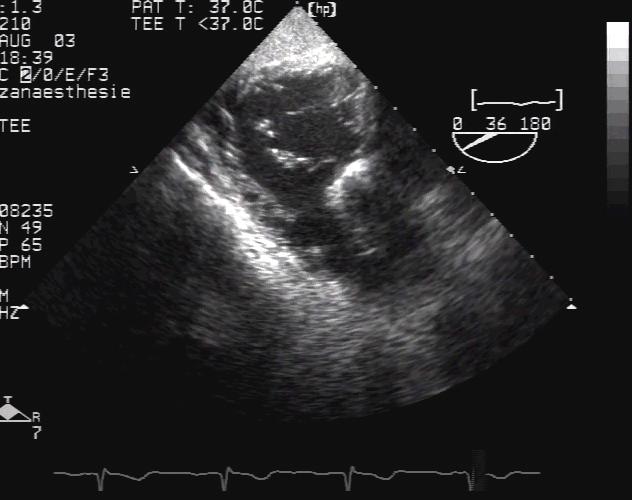 outflow tract; PTL: posterior tricuspid leaflet; ATL: