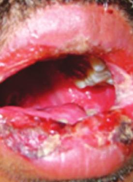 JCDP Oral Manifestation in Patients diagnosed with Dermatological Diseases Fig. 4: Steven Johnson syndrome (oral involvement) Fig.