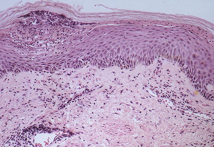 (1): A case of late psoriasis showing marked hyperkeratosis, parakeratosis and edematous dermal papillae with congested dilated blood vessels. Munro micro abscess is seen in stratum corneum (H&E 200).