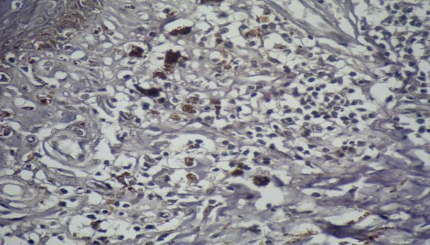 Small perivascular groups (positive) of CD30 + cells were also noted in the papillary and superficial reticular dermis.