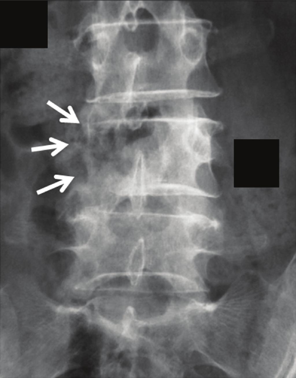 2 Figure 1: Plain radiographs (June 2006) at first consultation clearly show bone destruction of the right pedicle as the winking owl sign, which suggests a metastatic malignant tumor of the spine.