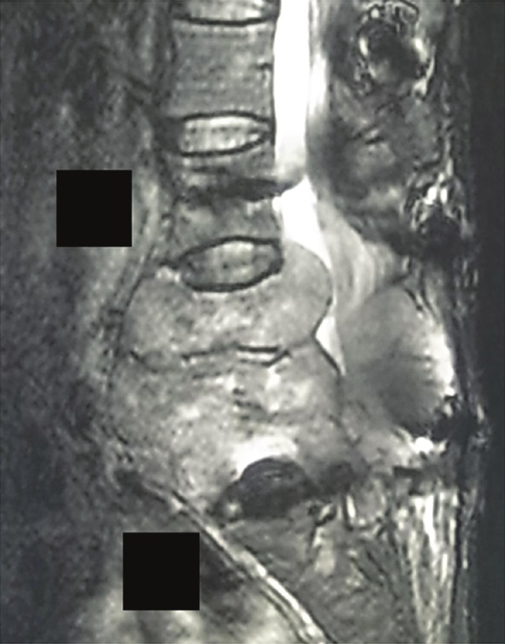 L5 Figure 5: MRI before the second surgery (February 2010) revealed a large mass compressing the neural tissue at the L3,, and L5 levels.