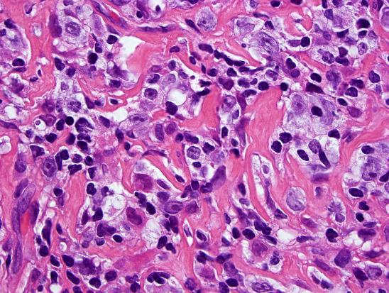 Primary mediastinal large B-cell lymphoma Young adults, more in females Bulky mediastinal mass; rarely outside Prominent sclerosis,