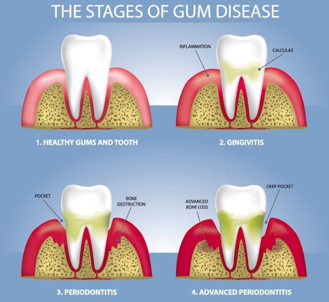 What is Dental Disease?