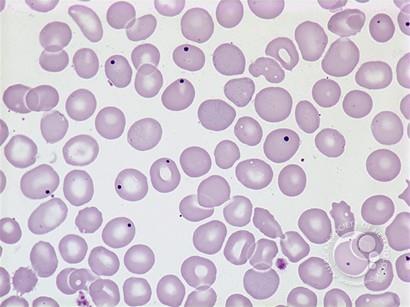 blood smear Hemoglobin