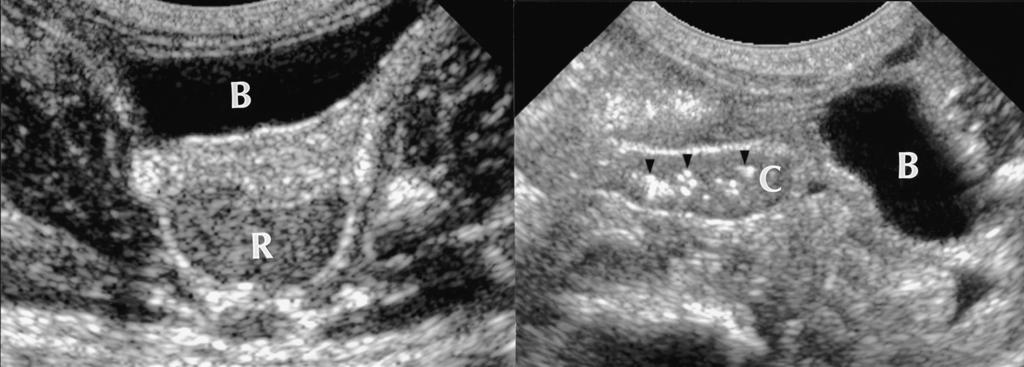 J Korean Radiol Soc 2004;50:281-288 A D B E F Fig. 1. A 7-day-old female premature newborn with meconium plug syndrome. A, B.