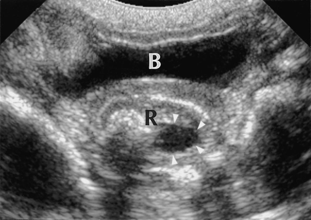 Administered Gastrografin (arrowheads) is seen as anechoic fluid in the large bowel extending from the rectum (R) to the cecum (C). Gastrografin did not mix with meconium plug but surrounded it. E, F.