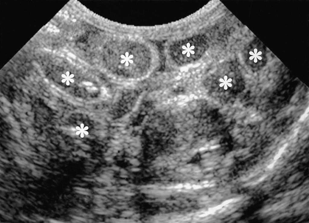 In contrast, one patient (case 1) in whom a microcolon was observed on initial sonography and whose ileal distension remained on follow-up sonography was found to have ileal stenosis during
