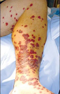 Arthritis Fever Skin