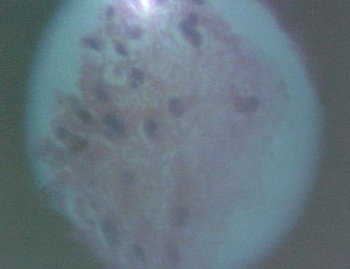 Histoplasmosis Picture