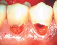 5. Where can I best use and other glass ionomer