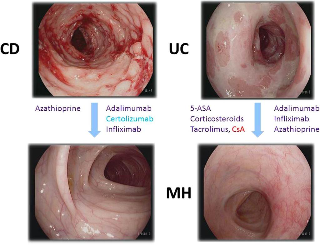 Endoscopic mucosal healing in IBD