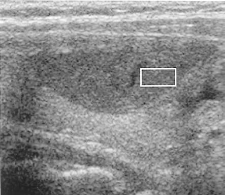 66 Thyroid nodule sonography with histopathologic correlation 4a Figure 4. Sonographic papillary cell cancer and its histopathology. The ROI in a.