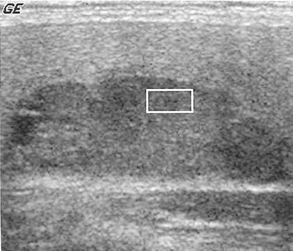 Discussion Six major hisopathologic compositions can be observed from routine thyroid ultrasound examination, including: (1) Calcifications: coarse or eggshell
