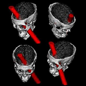 PHINEAS GAGE What happened to Gage? The iron rod went in under Gage's cheekbone, and came out through the top of his head. It destroyed most of the front of the left part of his brain.
