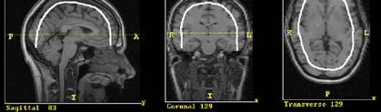 cranium for 2-3 cm In turn inducing an electric current in the brain This stimulates the firing of nerve cells and the