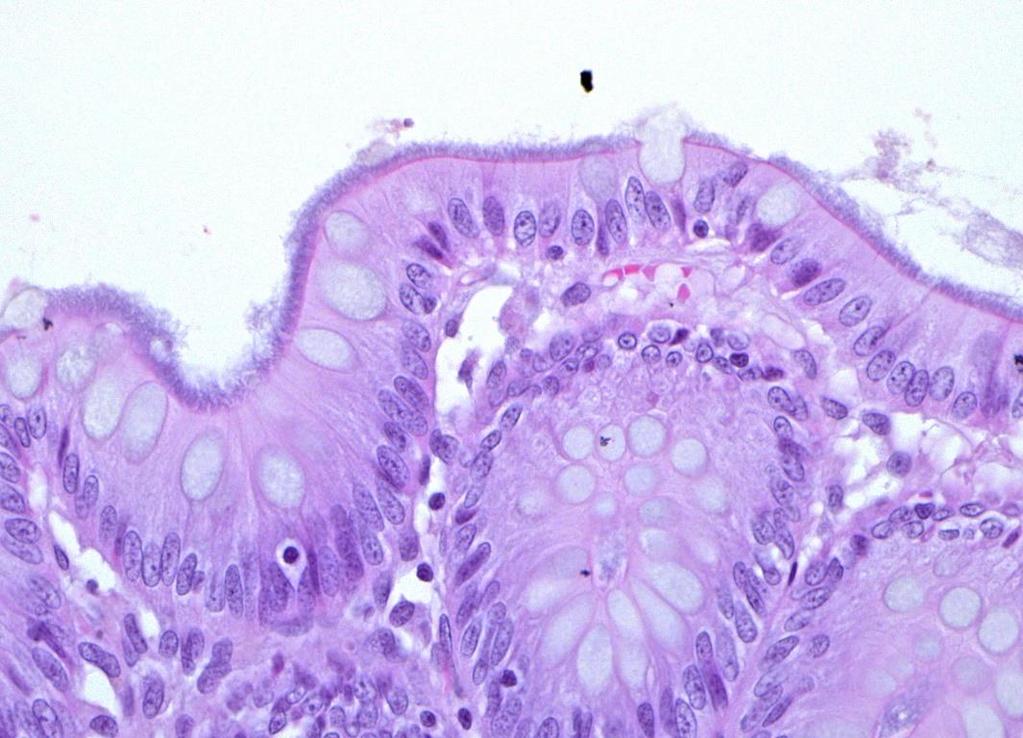 Intestinal Spirochetosis Brachyspira pilosicoli Possibly other weakly β- hemolytic species B.