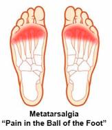 Metatarsalgia Aetiology Idiopathic Tight Achilles tendon Transfer metatarsalgia Inflammatory arthropathy High arch feet (Cavus)