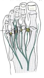 Morton s Inter-Digital Neuroma Sharp electric pain in forefoot Radiates into 3rd and 4th toes
