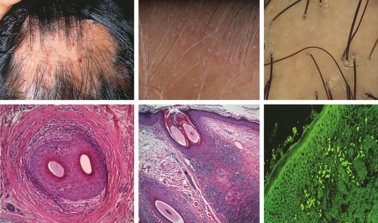 492 Diagnosis of primary cicatricial alopecia, M.J. Harries et al. Fig 8. Classic lichen planopilaris (LPP). (a) Loss of follicular ostia with active disease at the expanding edge of the lesion.